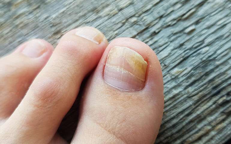 Laser Nail Fungus Treatment