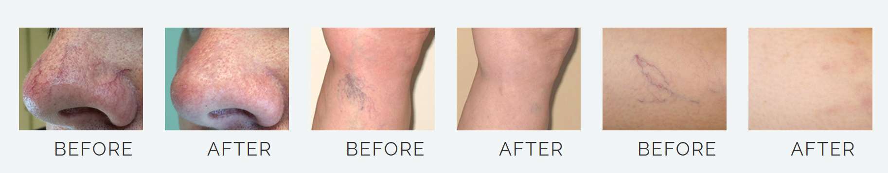 Laser Spider Vein Removal Before and After Laser Spider Vein Removal Before and After