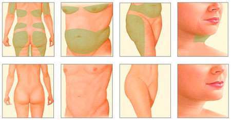 Laser Fat Removal Treatment Areas