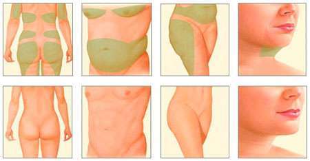 Laser Fat Removal Treatment Areas Laser Fat Removal Treatment Areas
