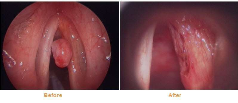 before after vocal cord polyp laser treatment before after vocal cord polyp laser treatment