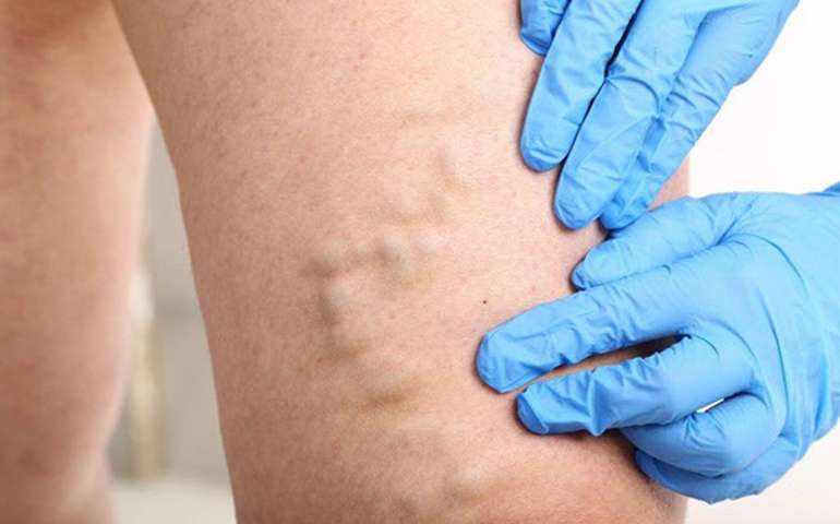 Endovenous Laser Ablation