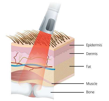 equine-laser-therapy-principle equine-laser-therapy-principle