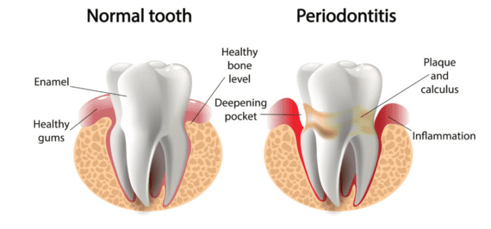 healthy gums vs bleeding gums