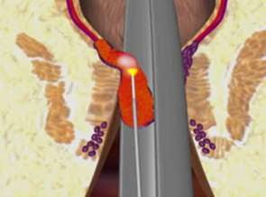 Hemorrhoid Treatment Laser Hemorrhoid Treatment Laser