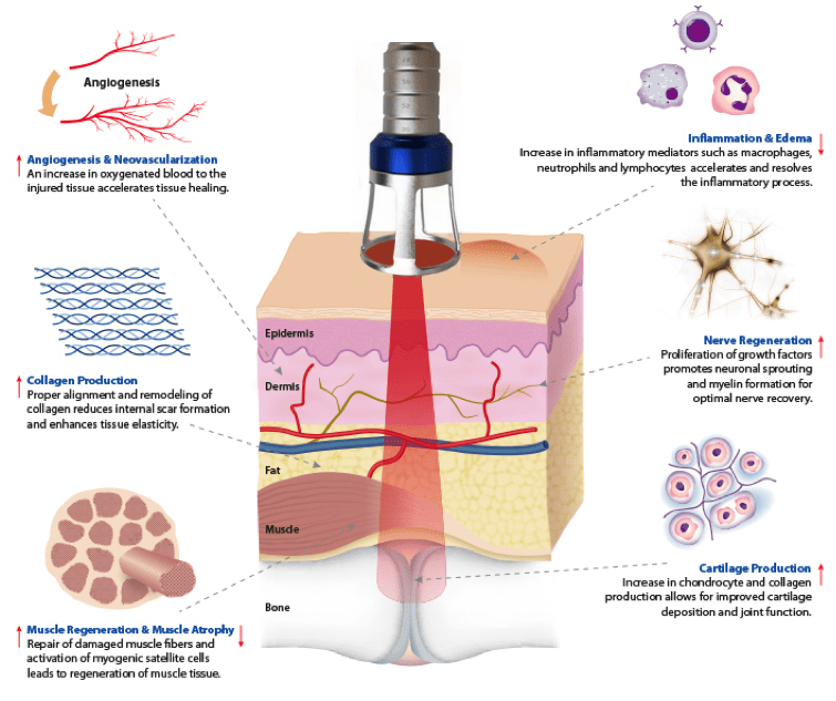high power laser therapy principle high power laser therapy principle