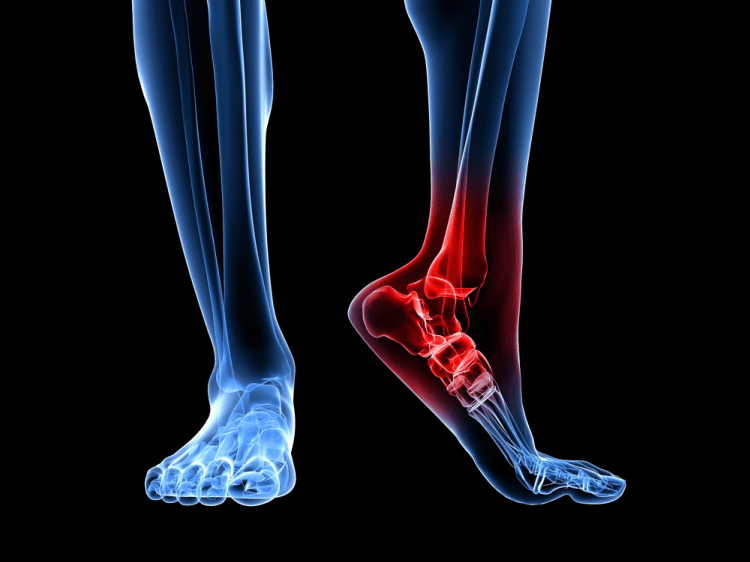 laser for plantar fasciitis laser for plantar fasciitis