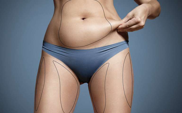 Laser Lipolysis