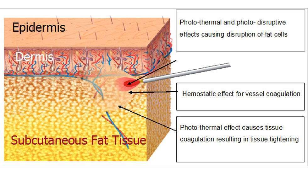 Laser Lipolysis Laser Lipolysis
