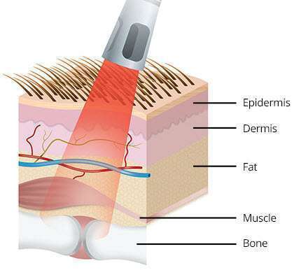 laser therapy diagram
