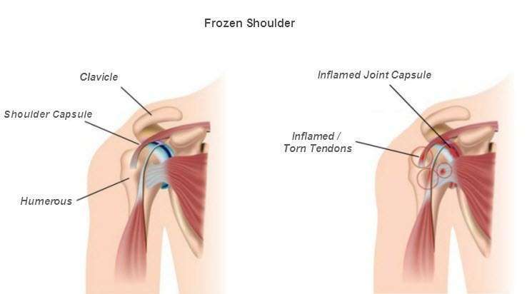 laser treatment for frozen shoulder