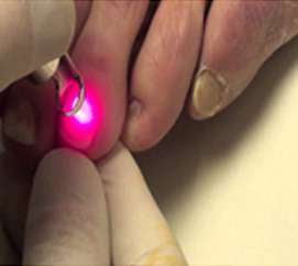 Laser Nail Fungus Laser Therapy Laser Nail Fungus Laser Therapy