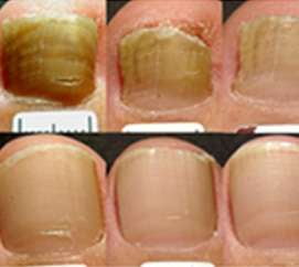 Laser Nail Fungus Therapy Laser Nail Fungus Therapy