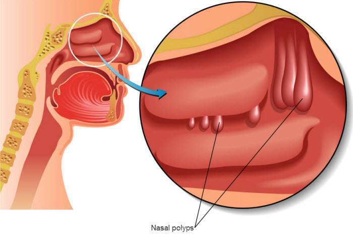 nasal-polyps-removal
