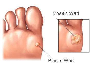 Solitary Warts and Mosaic Warts Treatment