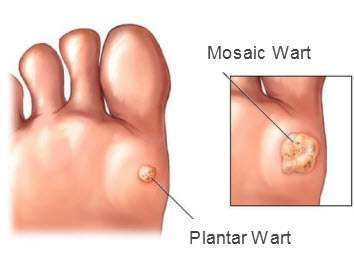Solitary Warts and Mosaic Warts Treatment Solitary Warts and Mosaic Warts Treatment