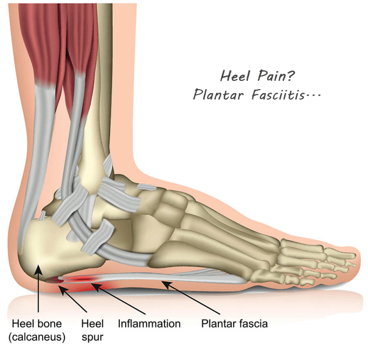 plantar fasciitis laser treatment plantar fasciitis laser treatment