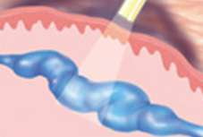 During Treatment
