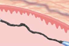 Immediately after Treatment