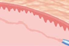 After Treatment