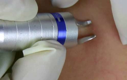 Laser Spider Vein Removal Laser Spider Vein Removal