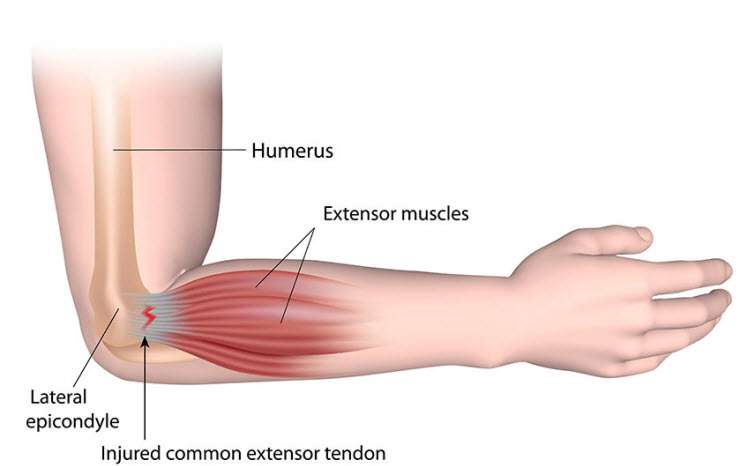 tennis elbow tennis elbow