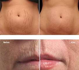 Laser Wrinkle Removal Laser Wrinkle Removal
